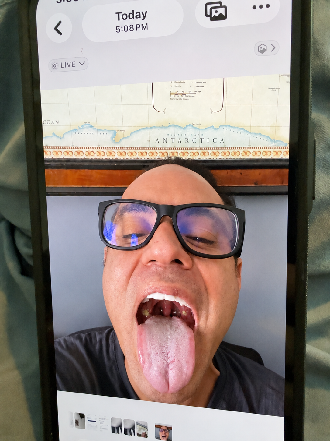 Digitally altered educational example showing white patches on the tonsils